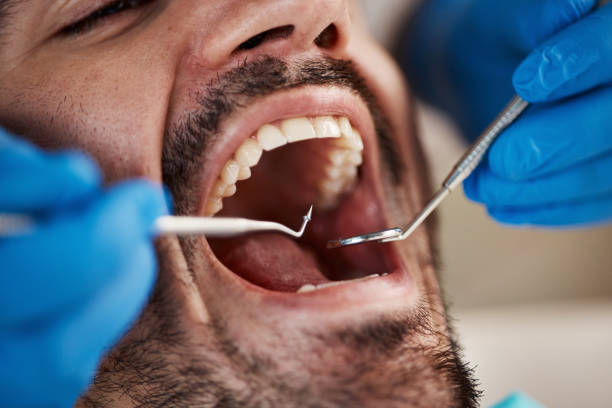 Best Emergency Treatment for Dental Infections or Abscesses in Cecilia, LA