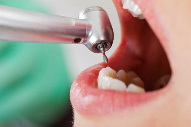 Best Emergency Wisdom Teeth Removal in Cecilia, LA